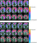 in <b>Lyme neuroborreliosis</b>