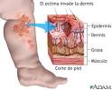 <b>Ectima</b> es una enfermedad de la