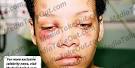 More Photos of Abused Rihanna Leak Urban Magazine