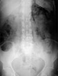 <b>retropneumoperitoneum</b>,