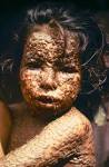 Smallpox – or how I learned to love child endangerment | Disease ...