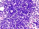 File:<b>Multiple myeloma</b> (2) HE