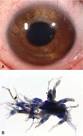 Heavily pigmented <b>iris tumor</b> www.sciencedirect.com