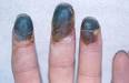 Buerger's Disease – Types of Vasculitis