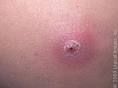 Boils (<b>Furunculosis</b>) Conditions, Treatment and Pictures for