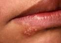 ORAL HERPES SIMPLEX INFECTIONS