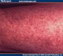 Unmasking Mastocytosis: Mastocytosis Classification