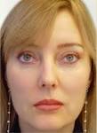 Endoscopic face lift