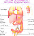 Scientist suggest new test for accurate diagnosis of ovarian ...