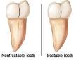Cracked Teeth and Avoiding Tooth Extraction