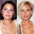 Victoria Beckham aka Posh Spice Nose Job - victoria-beckham-posh-spice-nose-job