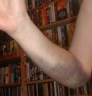 http://www.adrianbullock.com/images/brokenarm/9-days-lower-arm-bruising.jpg