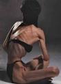 Anorexia Nervosa: Changing Ideal of Beauty or insane Obsession ...