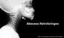 <b>Absceso</b> retrofaríngeo y