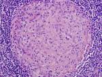 File:<b>Granuloma</b> mac.jpg
