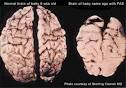 Mind and Body | Brain Damage Caused by Poor Nutrition