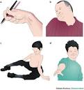 DYSTONIA refers to irregular,