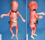 <b>gastroschisis</b> - Humpath.com