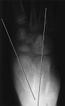 shows <b>equinus deformity</b>