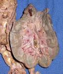 Acute <b>Nephrotic</b> Syndrome
