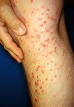 Fire ant - Wikipedia, the free encyclopedia