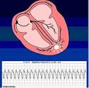causen una <b>taquicardia</b> SV,