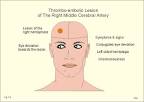 The <b>middle cerebral artery</b> is
