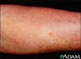 What is Mastocytosis?