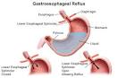 Acid reflux in children | Acid Reflux Disease Symptoms website