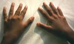 <b>Juvenile Rheumatoid Arthritis</b> Juvenile Rheumatoid Arthritis