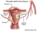 Uterine fibroids fact sheet | womenshealth.