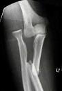 <b>Monteggia Fractures</b> in