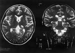 of <b>Lyme neuroborreliosis</b>: