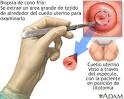 <b>Biopsia</b> de cono frío