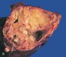 Teratoma - Wikipedia, the free encyclopedia