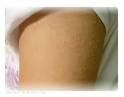 Picture of keratosis pilaris