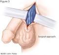 In this type of <b>varicocele</b>