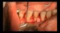 <b>Aumento</b> de <b>coroa clínica</b>. Sort by: time