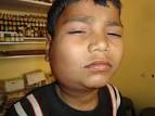 A case of Acute <b>parotitis</b>