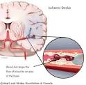Stroke - Ischemic stroke - Heart and Stroke Foundation of Canada