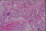 <b>Chondroblastoma</b> : Bone Cancer