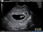 The Hendon Clinic - Fetal Viability & Dating Scan