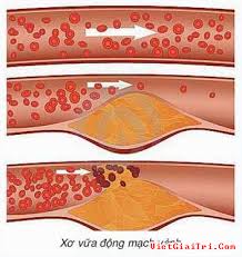 hạ mỡ m&aacute;u, bệnh tim mạch