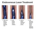 Varicose veins, spider veins, Northern Arizona Vein Center