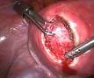 Uterine fibroid - Wikipedia, the free encyclopedia