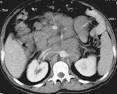 Scanner abdominal (