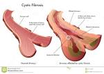 CYSTIC FIBROSIS Royalty Free Stock Photo - Image: 31724695