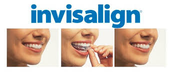 invisalign in Ottawa