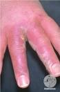 DermIS - Phototoxic Contact Dermatitis (