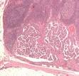 <b>Thyroid</b> cancer - Wikipedia, the free encyclopedia